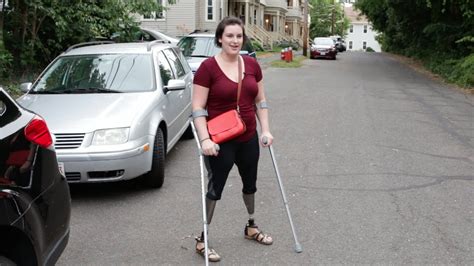 Clara Gardner Walking With Osseointegration Post Surgery Double Above