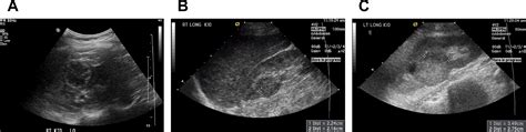 Ultrasound Of Renal Masses Radiologic Clinics