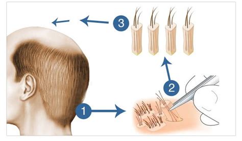 Hair Transplantation Insight Derma Clinic