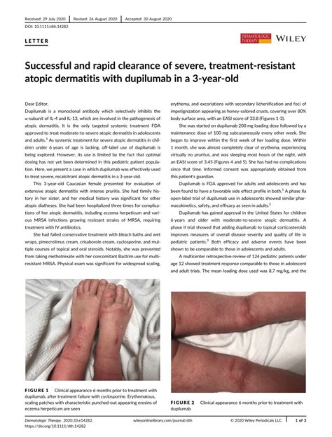 Successful And Rapid Clearance Of Severe Treatment‐resistant Atopic