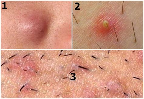 Armpit ingrown hair symptoms, causes & pictures. Drop Ten Years From Your Age With These Skin Care Tips ...