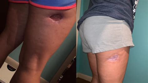Reddit User Shares Photos Of One Womans Recovery From