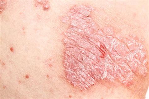 Psoriasis Causes Types And Treatment Dermatological Society Of