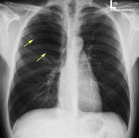 Öppna alla | stäng alla. pneumothorax - meddic