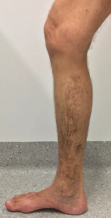 Varicose Vein Results And Post Treatment Photos — The Leg Vein Doctor