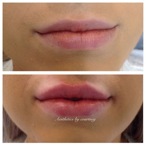 Pin By K Thompson On Botox And Fillers Botox Lips Lip Fillers Facial