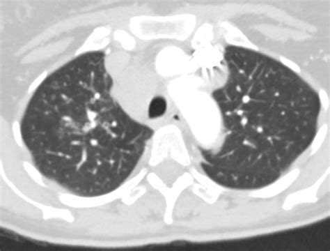 049lu Tb Scrofula Lymphadenitis Pericarditis Lungs