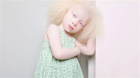 Pictured People Living With Albinism Reveal The Human Side Behind