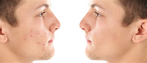 How To Lighten Dark Spots On Skin From Acne