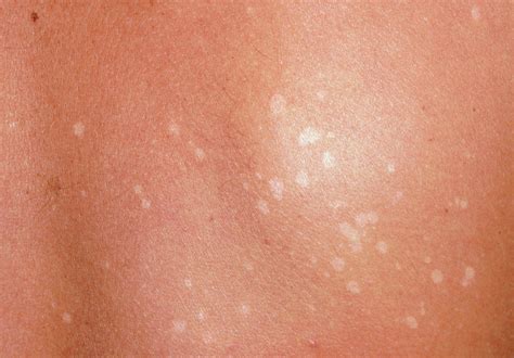 Pityriasis Versicolor Light Patches On Skin Photograph By Dr P Marazzi Science Photo Library