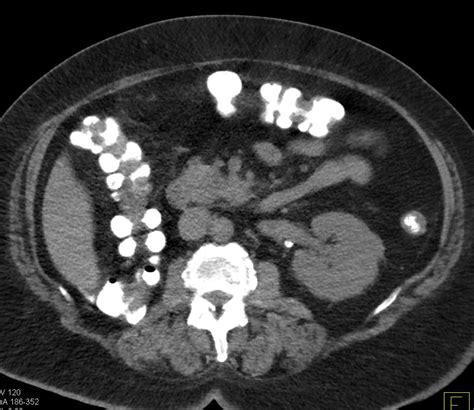 Recurrent Renal Cell Carcinoma Metastatic To The Pancreas