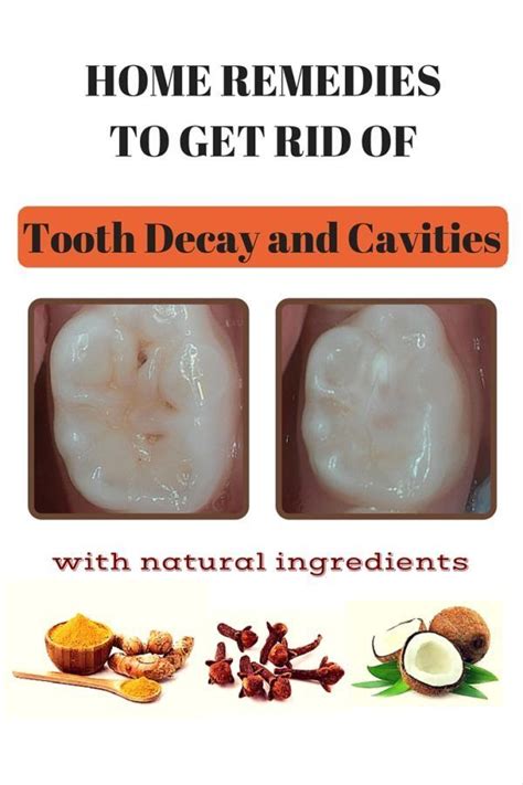 Watch this video to learn home remedies for tooth cavities. Home Remedies to Get Rid of Tooth Decay and Cavities ...