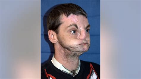 virginia man 37 receives first comprehensive face transplant fox news