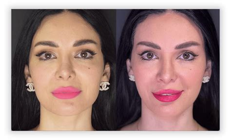 Before And After Non Surgical Cosmetic Treatments Greater Toronto Area