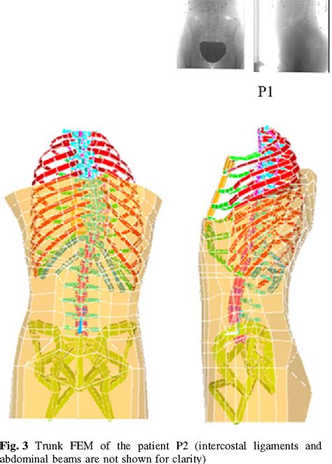 Comparison Of The Biomechanical 3d Efficiency Of Different Brace