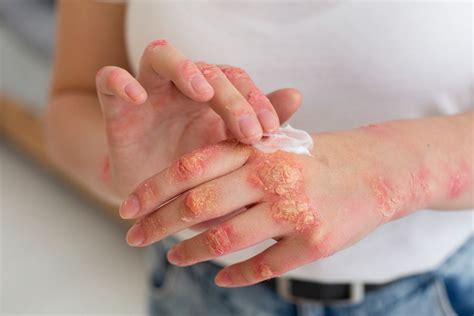 Eczema Vs Psoriasis Whats The Difference Hanna Sillitoe