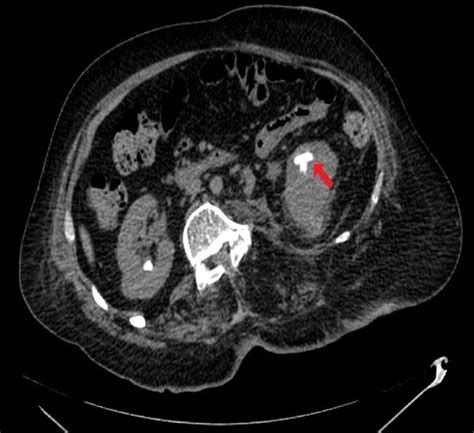 Ct Of Urinary Tract Note Performed 4 Weeks After The Third