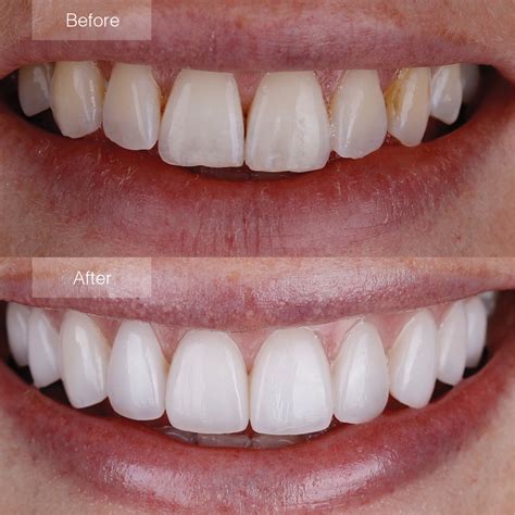 Porcelain Veneers Before And After The Dental Room