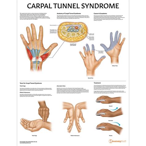 Carpal Tunnel Syndrome Poster Pathology Anatomy Chart