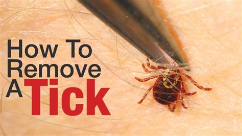 How To Remove A Tick Youtube