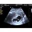 Baby At 8 Weeks Ultrasound  All You Need Infos
