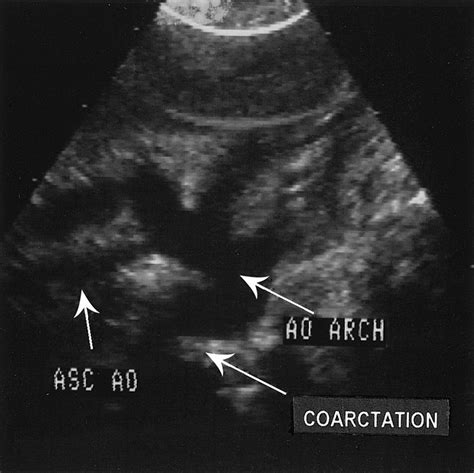 Hypoplastic Left Heart Syndrome Radiographics