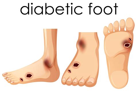 Evidence Based Therapies In Diabetic Foot Ulcers Iwound Learning