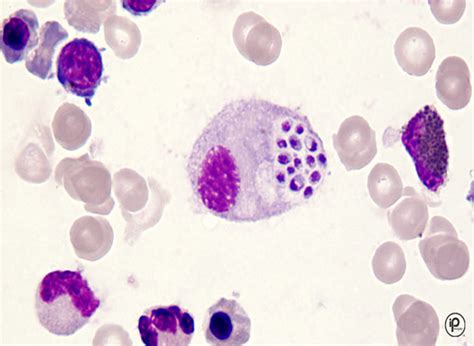 Atypical Lymphocytes In Blood Smear Michaeltrombley