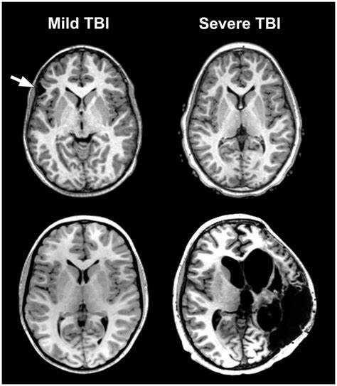 The Problem Of Traumatic Brain Injury Tbi Severity Classification By