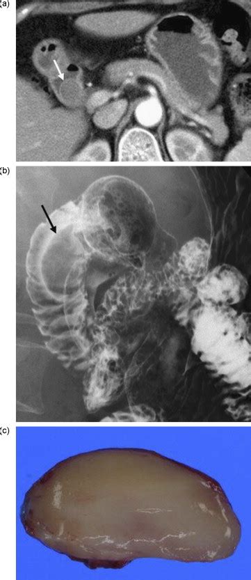 Benign Submucosal Lesions Of The Stomach And Duodenum Imaging Characteristics With Endoscopic