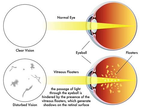 Vitreous Haemorrhage Exeter Eye