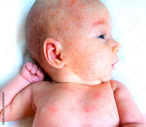 Fotka „baby Allergy Skin Child Dermatitis Symptom Problem Rash