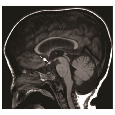 A Cranial Mri Of Case 1 Obtained At The Age Of 8 Years Reveals