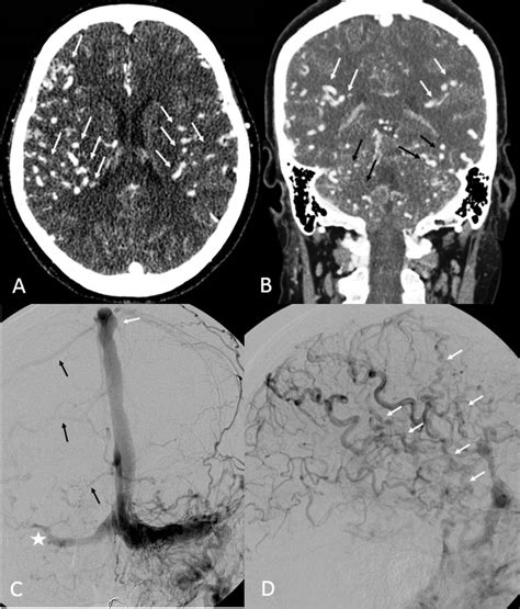 Engorged Medullary Vein On Ct Angiography In Patients With Dural