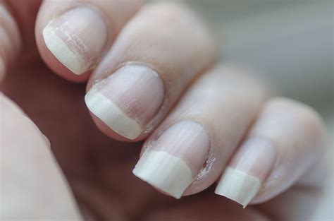 Brittle Nails Symptoms Causes And Treatment