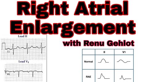 Right Atrial Enlargement ECG P Pulmonale ECG Criteria Of Right