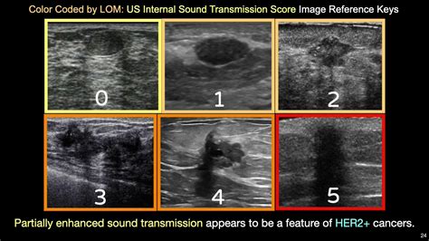 Us Features Of Solid Breast Masses As Prognostic Biomarkers Youtube