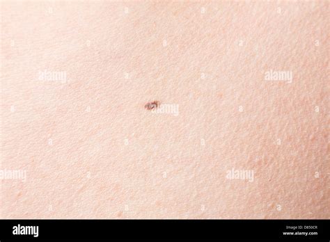 Skin Cancer Mole Stock Photos And Skin Cancer Mole Stock Images Alamy