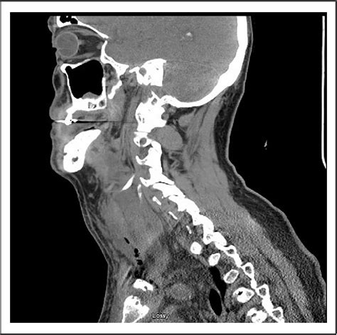 Figure From Sternoclavicular Joint Septic Arthritis Presenting As Cervical Abscess And