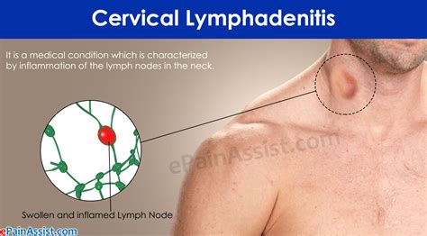 Cervical Lymphadenitiscausessymptomstreatmentrisk Factorscoping Tips