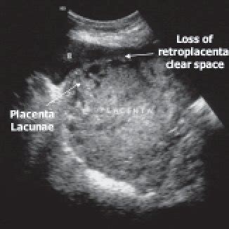 Placenta Lesions Imaging Placenta Accreta Obstetrics Cervix Mri The