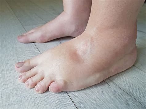 5 Potential Causes Of Swollen Or Inflamed Feet Apple Podiatry Group