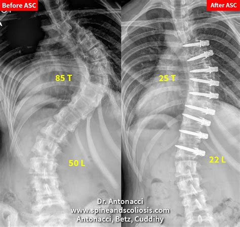 Thoracic Spine Scoliosis Causes Symptoms And Treatment Brandon Orthopedics