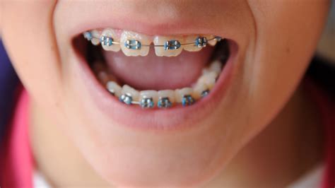 Feb 01, 2020 · so, when you begin wearing a retainer, you should wear it pretty much consistently about a year, after that you can gradually decrease usage. Want straight teeth? Brace retainers 'should be worn for ...