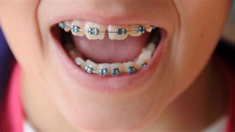 Maybe you would like to learn more about one of these? Want straight teeth? Brace retainers 'should be worn for ...