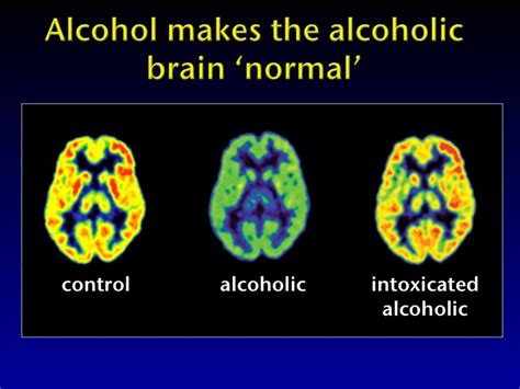Brain States Alcoholism Firing Neurotransmitters Pinterest