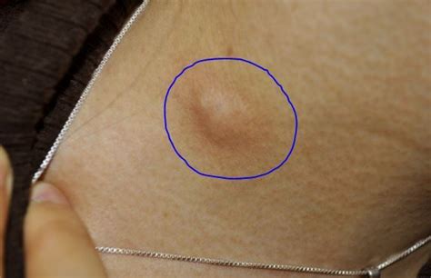 Individuals who shave the underarms can easily get lumps or bumps due to the irritation of the skin from razors. Lump Under Armpit, Painful, Hard Male, Female Sore Small ...