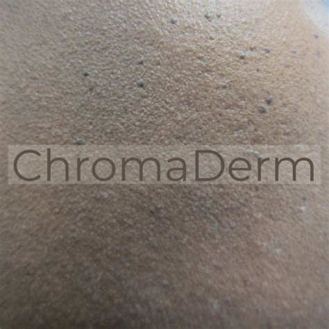 What Are Those Brown Spots On My Face Doctor Chroma Dermatology