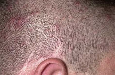 Permalink To Is Accutane Helpful For Scalp Acne Pimples On Scalp