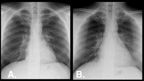 Chest X Ray Basics Pa Vs Ap Radrounds Radiology Network